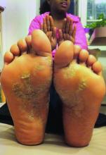 psoriasis on the feet of a child